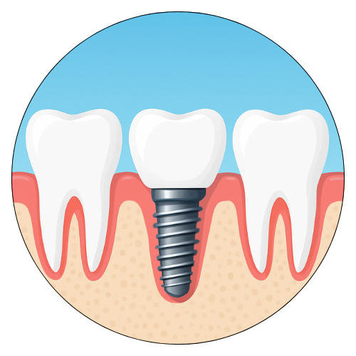 Dental Implants