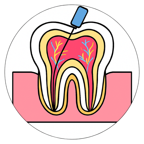 Root Canal Treatment